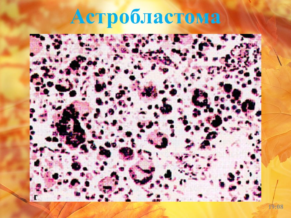 тучноклеточная астроцитома. характеристика астробластомы. тучные астроциты гистология. протоплазматическая астроцитома. глиобластома патологическая анатомия.