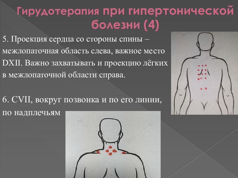 Места постановки. Курс гирудотерапии при гипертонии. Межлопаточный триггер с левой стороны последствия.