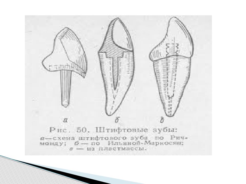 Штифтовый зуб по ричмонду. Штифтовые зубы по Ричмонду Ильиной-Маркосян Ахмедову. Штифтовый зуб по л.в. Ильиной-Маркосян. Ильина Маркосян штифтовый зуб. Штифтовая конструкция по Ричмонду.