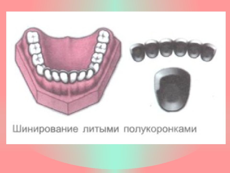 Постоянное шинирование при заболеваниях пародонта презентация