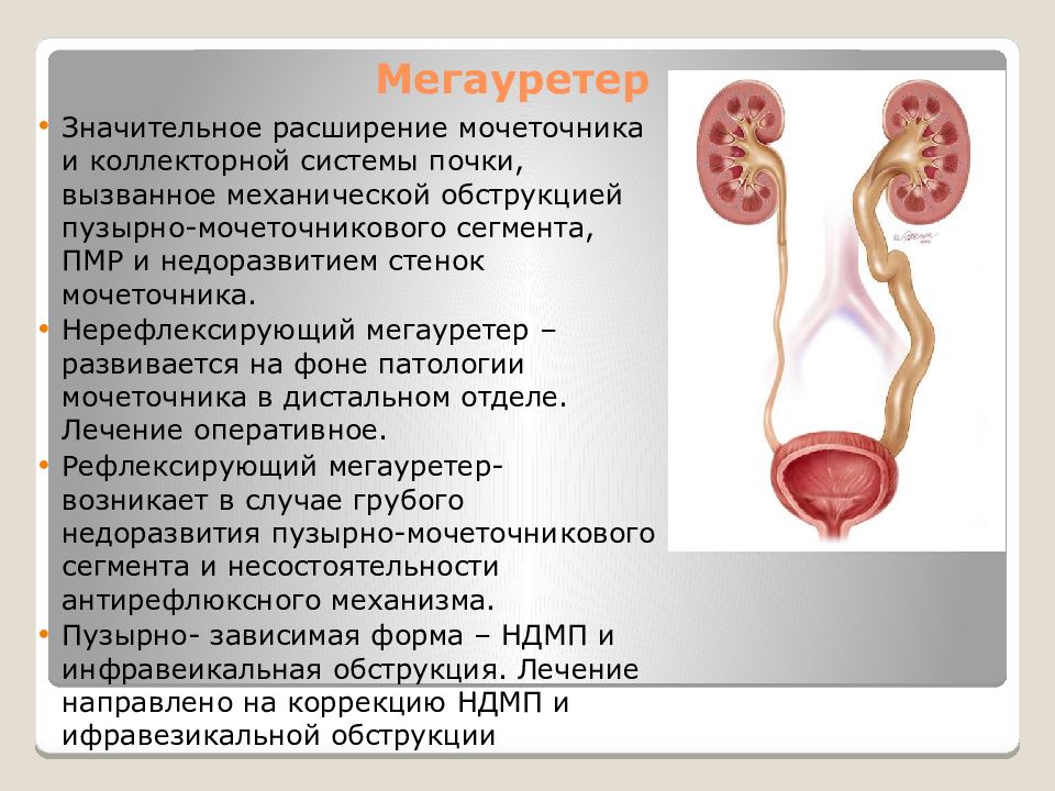 Сильная боль по ходу мочеточника. Рефлюксирующий мегауретер. Гидронефроз мочеточника. Мегалоуретер мочеточника. Расширение мочеточника мегауретер.