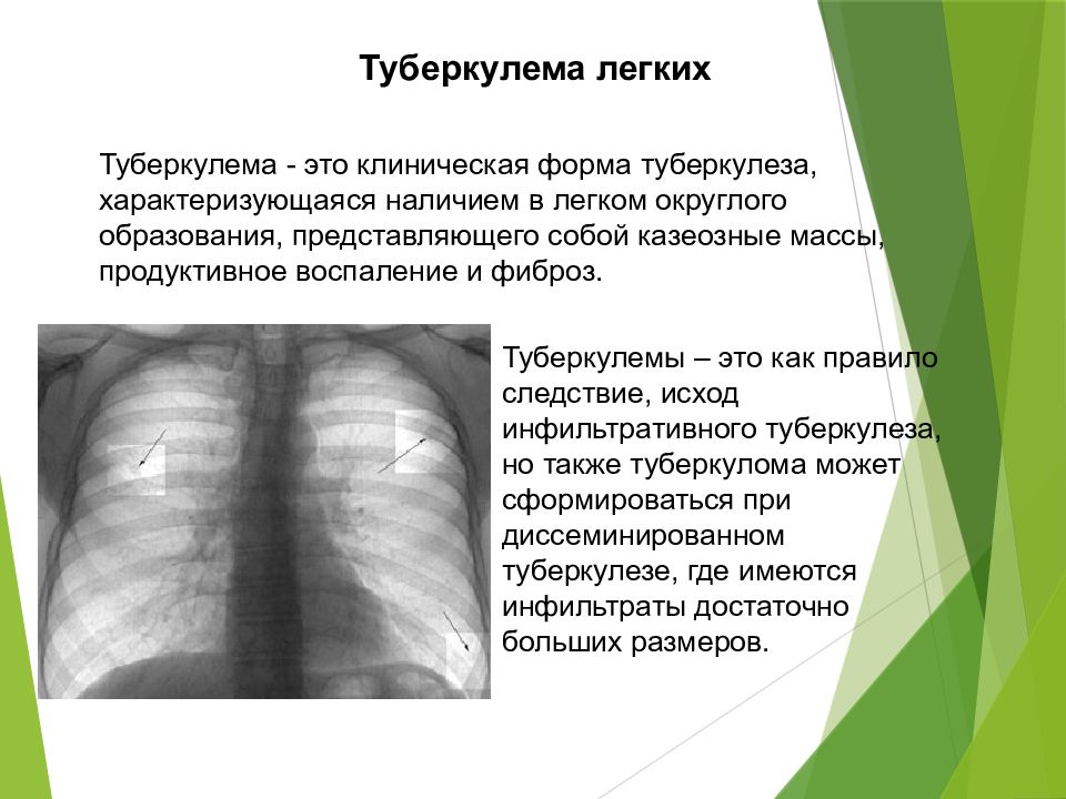 Туберкулема. Туберкулема фтизиатрия. Лекция про туберкулез для детей.