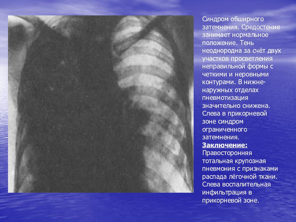 Просветление в легких. Тень средостения на рентгенограмме. Синдром затемнения и просветления. Тень в Верхнем средостеньи рентген. Тень верхнего средостения.