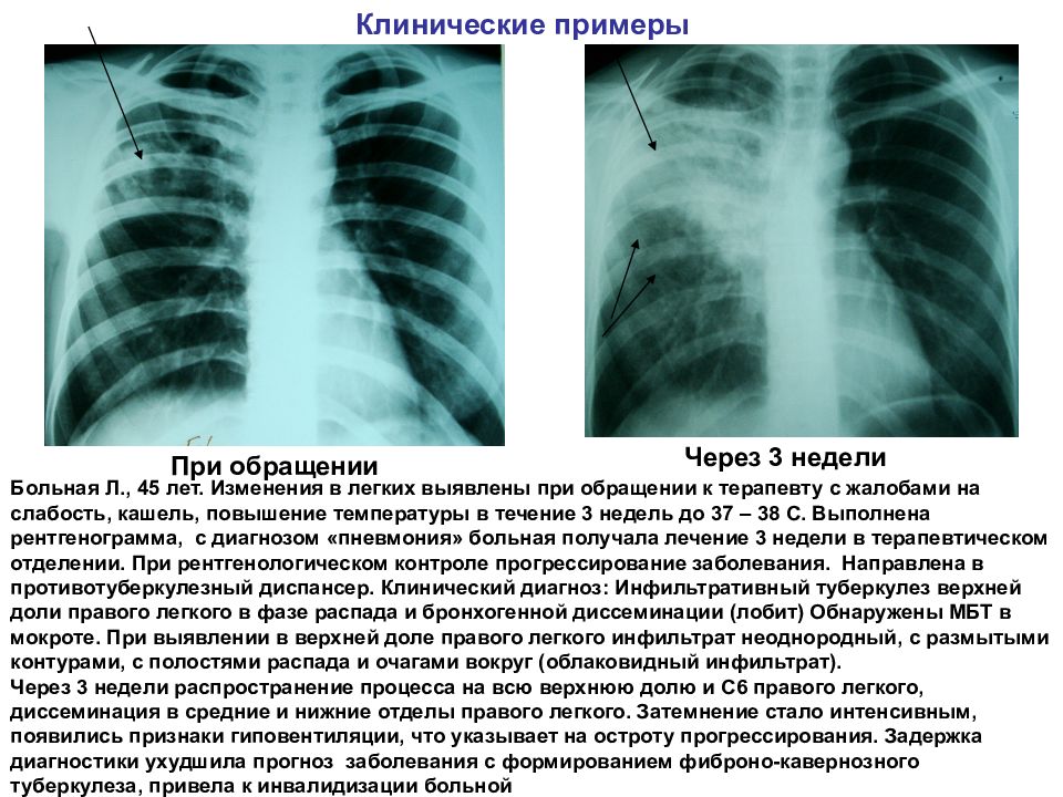 Очаговый и инфильтративный туберкулез презентация