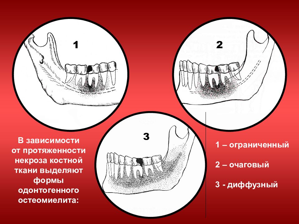 Одонтогенные осложнения. Остеомиелит альвеолярного отростка верхней челюсти. Одонтогенный остеомиелит челюсти. Травматический остеомиелит челюсти симптомы. Хронический остеомиелит челюсти снимок.