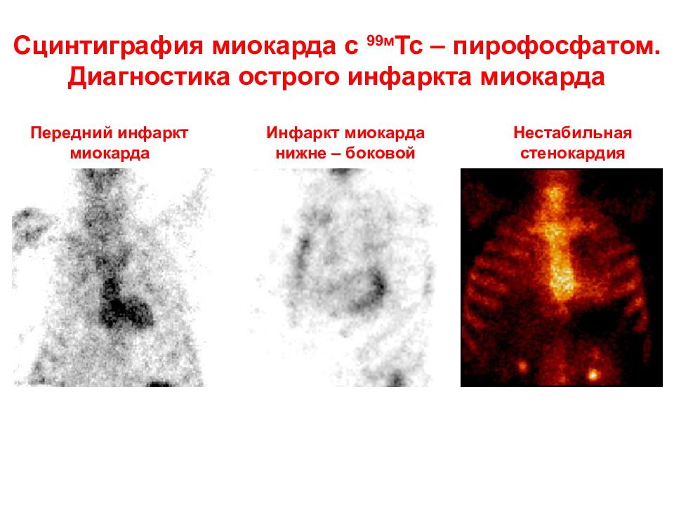 Презентация сцинтиграфия миокарда