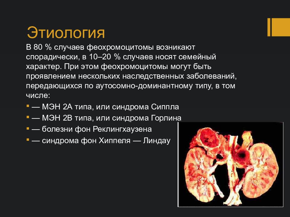 Феохромоцитома у детей презентация