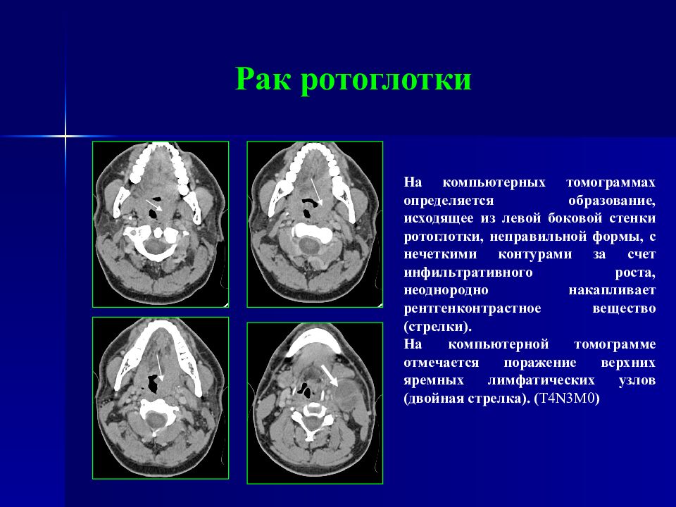 Рак Горла Стадии Фото