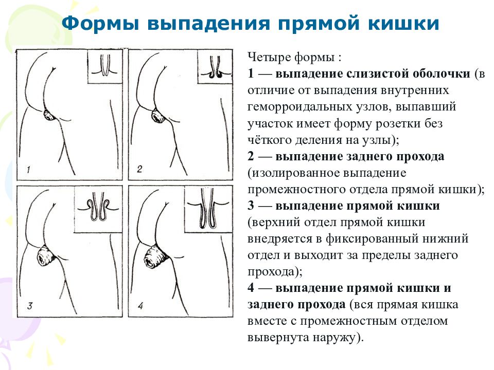 Выпадение прямой кишки презентация