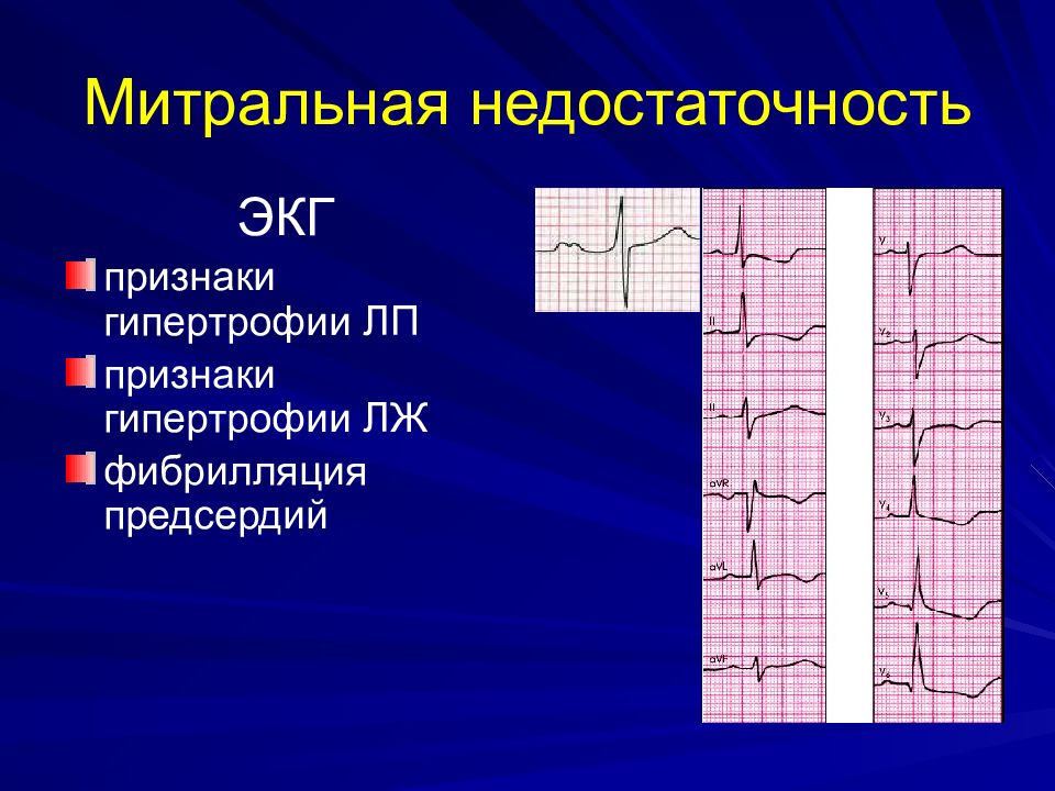 Экг признаки. ЭКГ при недостаточности митрального клапана. ЭКГ при митральной недостаточности. Изменения ЭКГ при митральной недостаточности. ЭКГ при пороках митрального клапана.