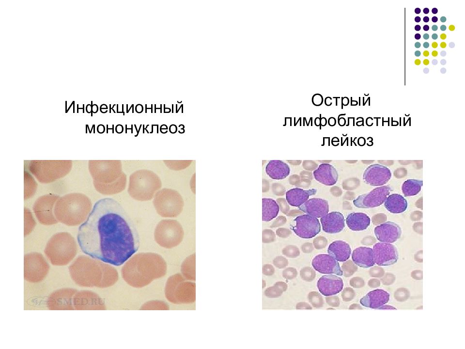 Острый лимфобластный лейкоз мкб. Атипичные лимфоциты мононуклеоз. Инфекционный мононуклеоз лимфоцитоз. Мононуклеоз картина крови. Картина крови при мононуклеозе у детей.