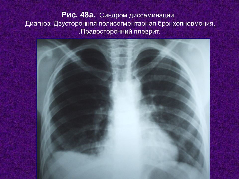 Бронхопневмония у детей. Очаговая бронхопневмония рентген. Правосторонняя бронхопневмония рентген. Полисегментарная бронхопневмония. Мелкоочаговая пневмония.