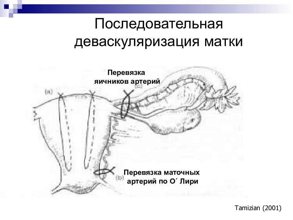 Перевязка маточных сосудов. Перевязка маточно-яичниковых сосудов. Перевязка магистральных сосудов матки. Лигирование маточных артерий. Лигирование сосудов матки.