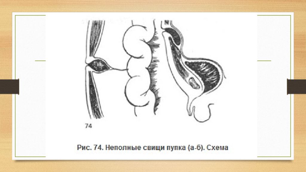 Свищ Фото Лечение