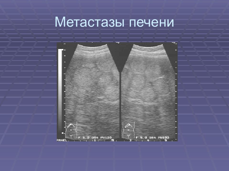 Метастазы в печени на узи