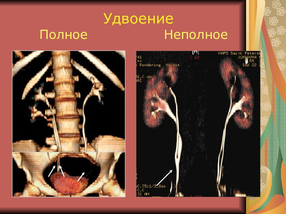 Удвоение почки. Неполное удвоение почки рентген. Врожденные аномалии развития чашечно лоханочной системы почки. Неполное удвоение ЧЛС рентген. Неполное удвоение ЧЛС кт.