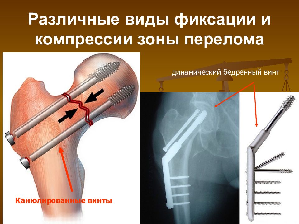 Виды фиксации. Динамический бедренный винт DHS. Остеосинтез бедра динамическим винтом. Остеосинтез бедренной кости динамическим бедренным винтом. Динамический Тип фиксации бедренного винта.