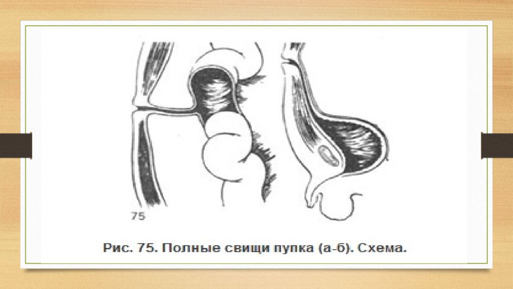 Международный день по искоренению акушерских свищей картинки