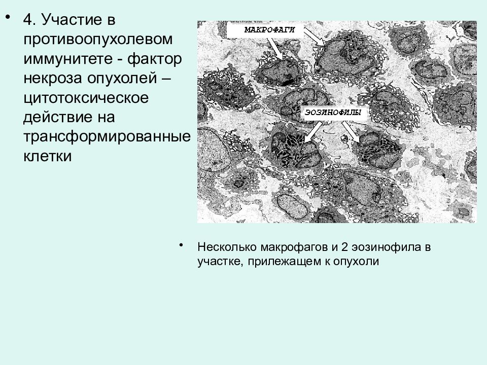 Обнаружены клетки трансформации. Функции макрофагов соединительной ткани. Некроз опухолевой ткани. Противоопухолевые иммунные факторы.