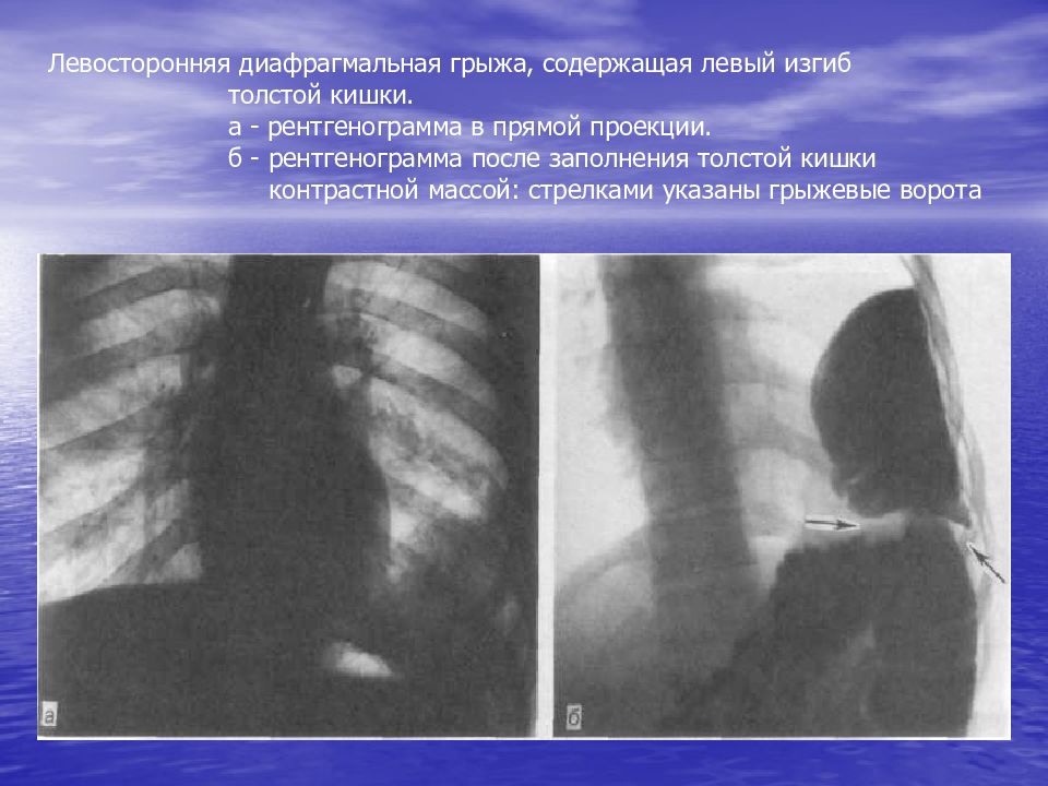 Диафрагмальная грыжа. Диафрагмальная грыжа Бохдалека на кт. Грыжа Бохдалека рентген. Левосторонняя диафрагмальная грыжа. Диафрагмальная грыжа на флюорографии.