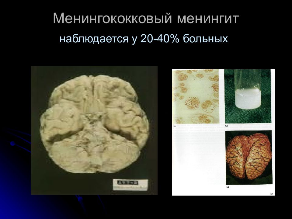 Менингококковый менингит. Менингит и менингококковая инфекция. Фульминантный менингит. Менингококковый менингит патанатомия. Менингококковый менингит неосложненный.