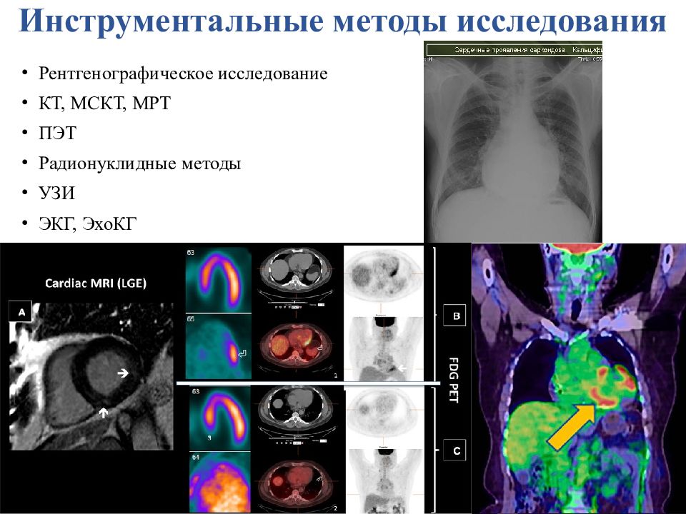 Саркоидоз лимфатических узлов кт.