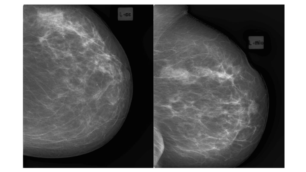 Маммография ростов на дону. Липома молочной железы маммограмма. Атерома молочной железы маммография. Фибролипома молочной железы маммография. Мастопатия на маммографии.