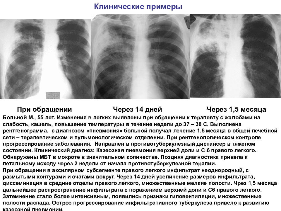 Очаговый и инфильтративный туберкулез презентация