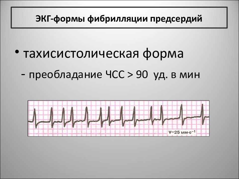 Пароксизмальная форма фибрилляции предсердий. Фибрилляция предсердий ЭКГ тахисистолия. Фибрилляция предсердий тахисистолическая форма ЭКГ. Тахиформа фибрилляции предсердий на ЭКГ. Постоянная фибрилляция предсердий тахисистолическая форма.