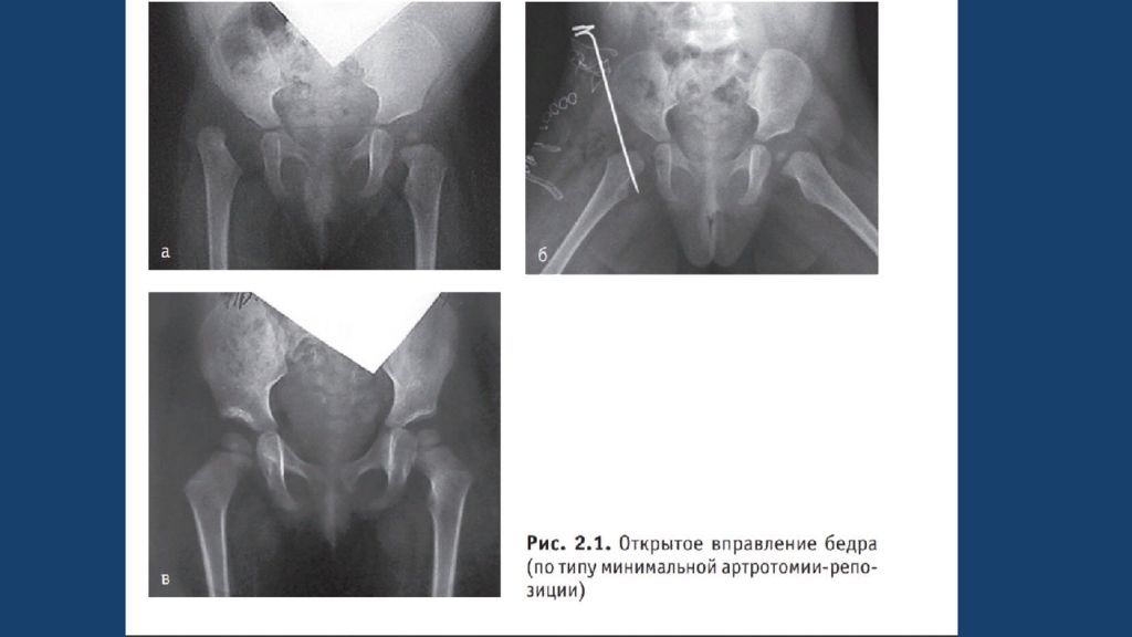 Врожденный вывих бедра презентация травматология