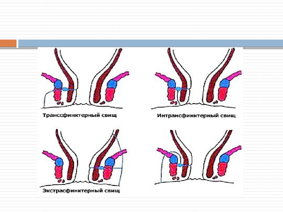 Свищ это простыми словами. Транссфинктерные свищи. Экстрасфинктерный свищ прямой кишки. Транссфинктерный свищ операция.