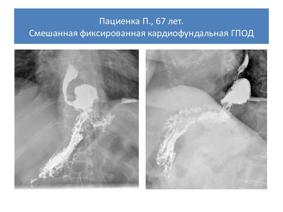 Эндоскопические признаки гпод. Параэзофагеальная грыжа рентген. Скользящая грыжа пищевода рентген. Аксиальная грыжа пищевода рентген. Кардиофундальная грыжа рентген.