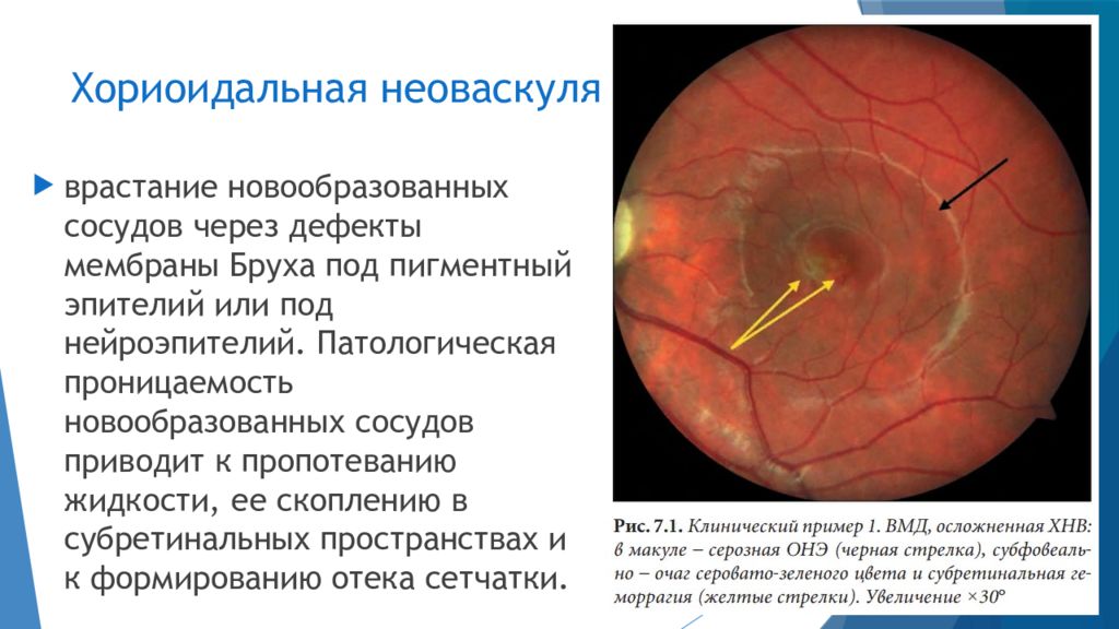 Возрастная макулярная дегенерация презентация