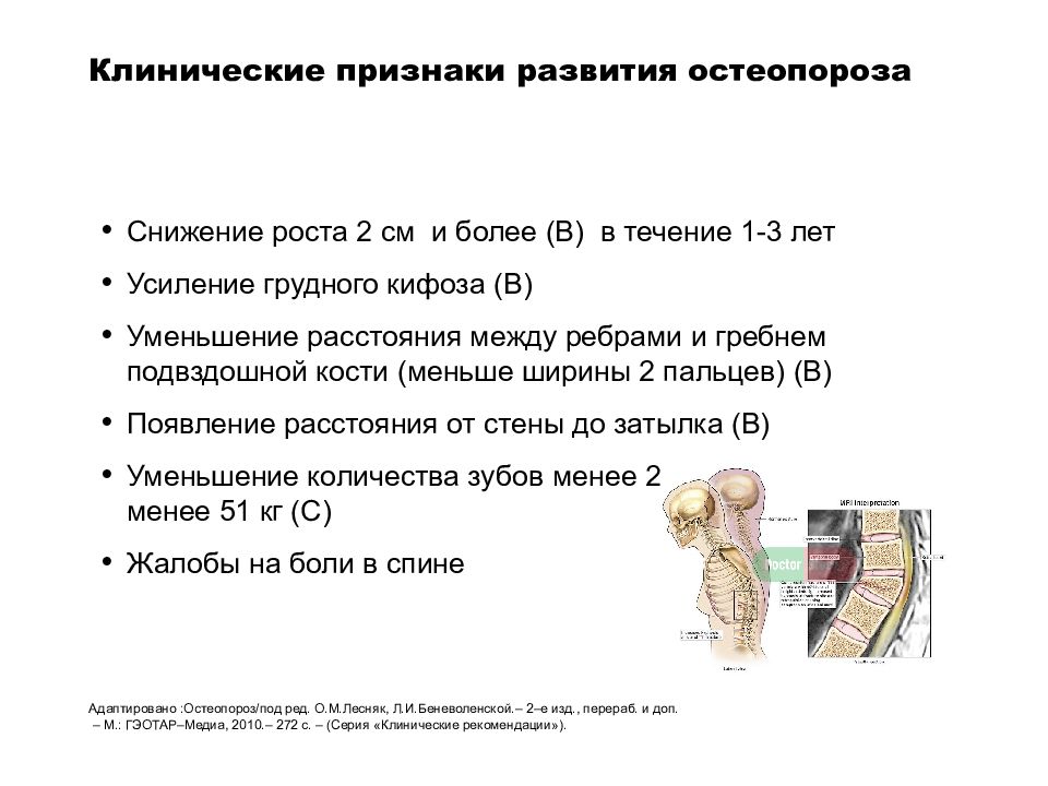 Признаки остеопороза