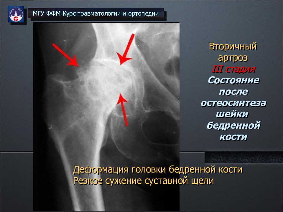 Асептический некроз тазобедренного сустава. Идиопатический некроз головки бедра. Некроз головки тазобедренного сустава УЗИ. Идиопатический асептический некроз кости. Деформация головки и шейки бедренной кости.