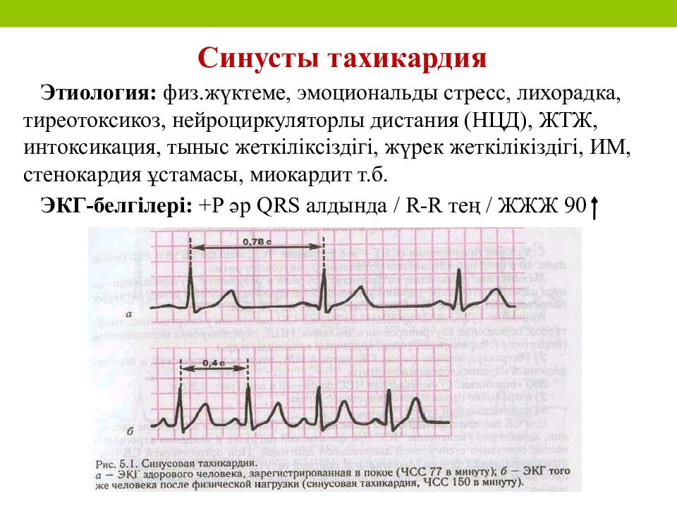 Признаки тахикардии на экг. Синусовая тахикардия ЭКГ признаки. Синусовая тахикардия на ЭКГ. Тахикардия на ЭКГ. ЭКГ при синусовой тахикардии сердца.