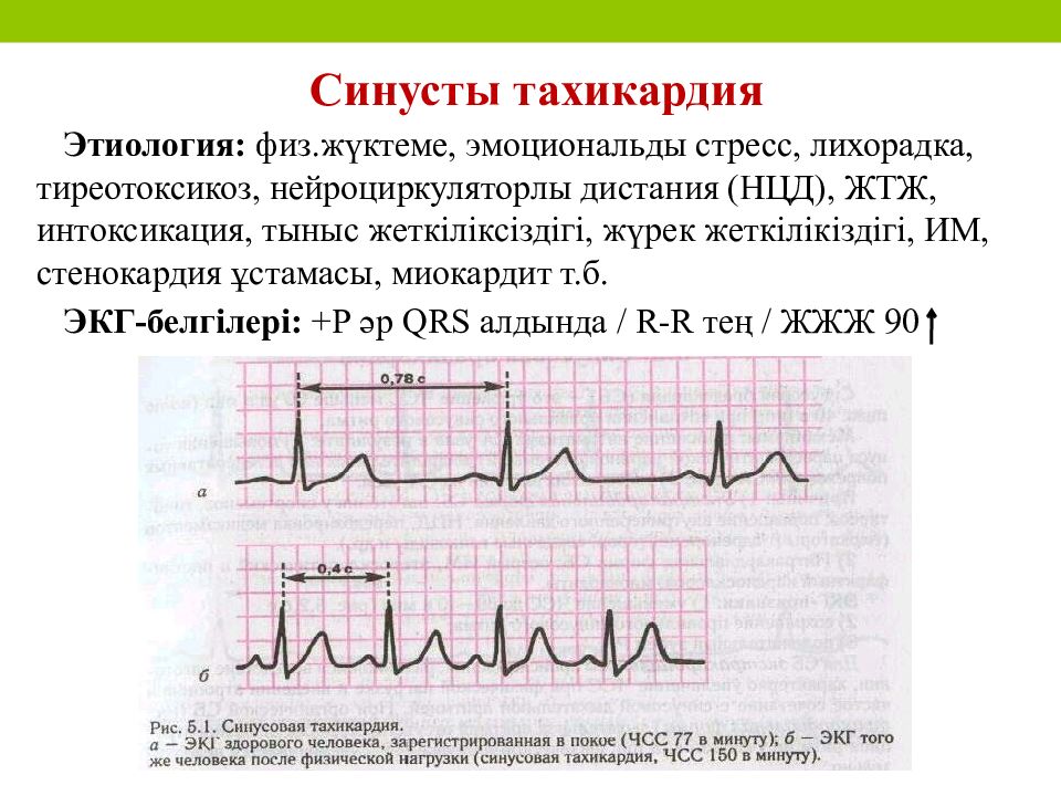 Тахикардия на экг