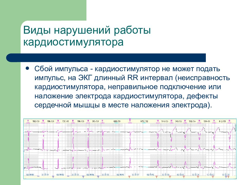 Экг с кардиостимулятором картинки