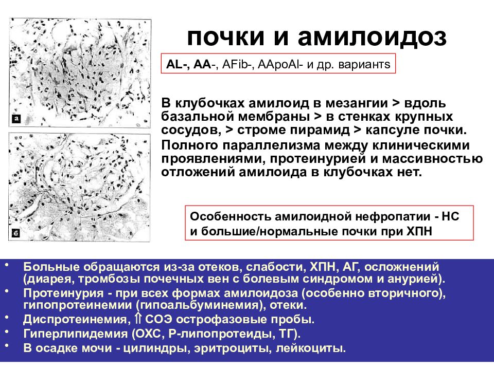 Амилоидоз почки рисунок