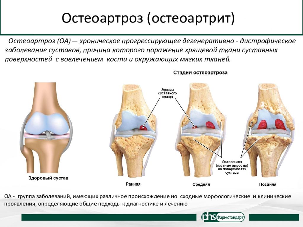 Остеоартроз что это такое как лечить. Деформирующий остеоартроз поражение суставов. Остеоартрит (артроз, дегенеративные заболевания суставов). Деформирующий артроз коленного сустава классификация. Гонартроз коленного сустава патогенез.