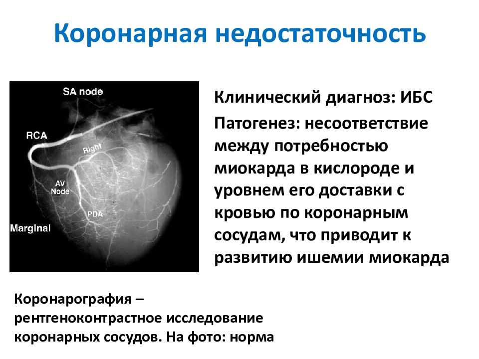 Коронарный сердца. Клинические проявления коронарной недостаточности. Последствия острой коронарной недостаточности. Острая коронарная недостаточность симптомы. Синдром острой коронарной недостаточности симптомы.