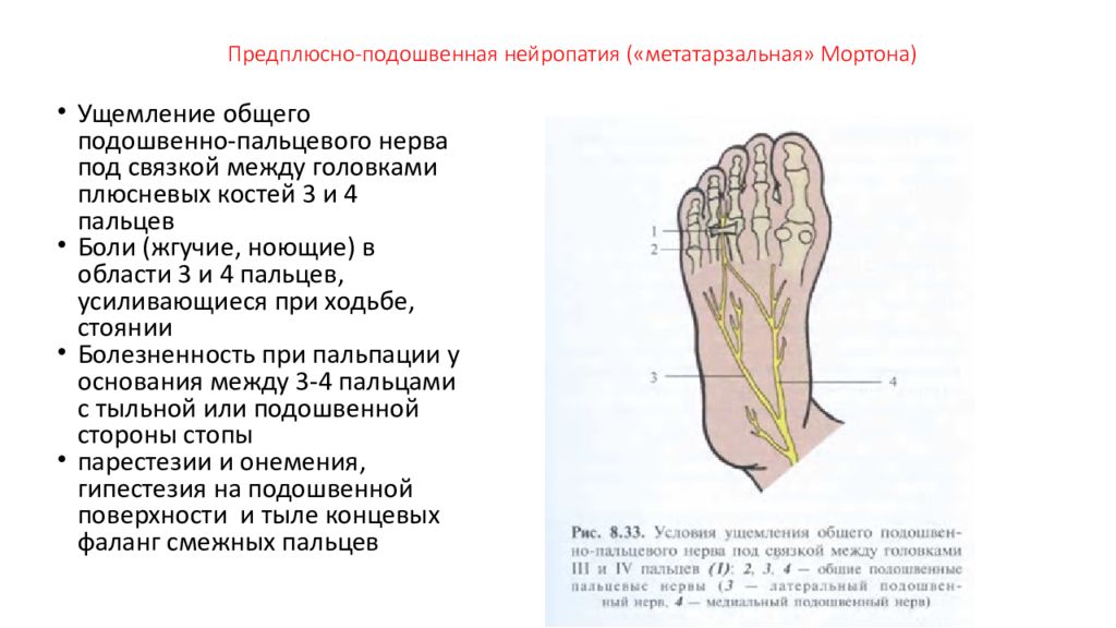 Подошвенная нейропатия. Предплюсна подошвенная нейропатия. Подошвенный нерв область иннервации. Туннельная невропатия стопы. Латеральный подошвенный нерв.