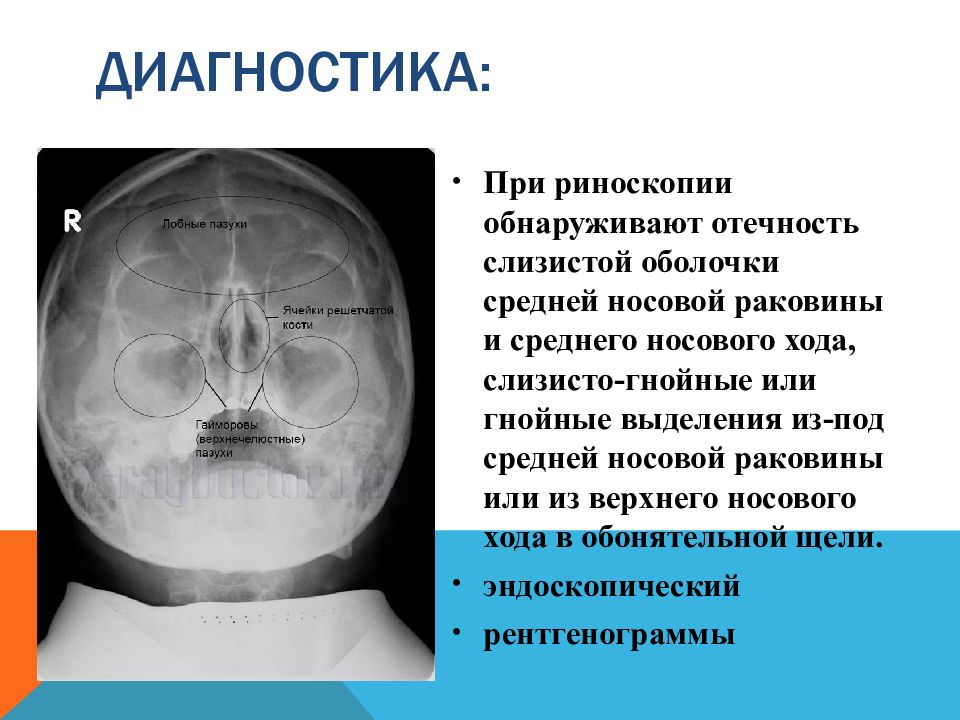 Рак полости носа и придаточных пазух презентация