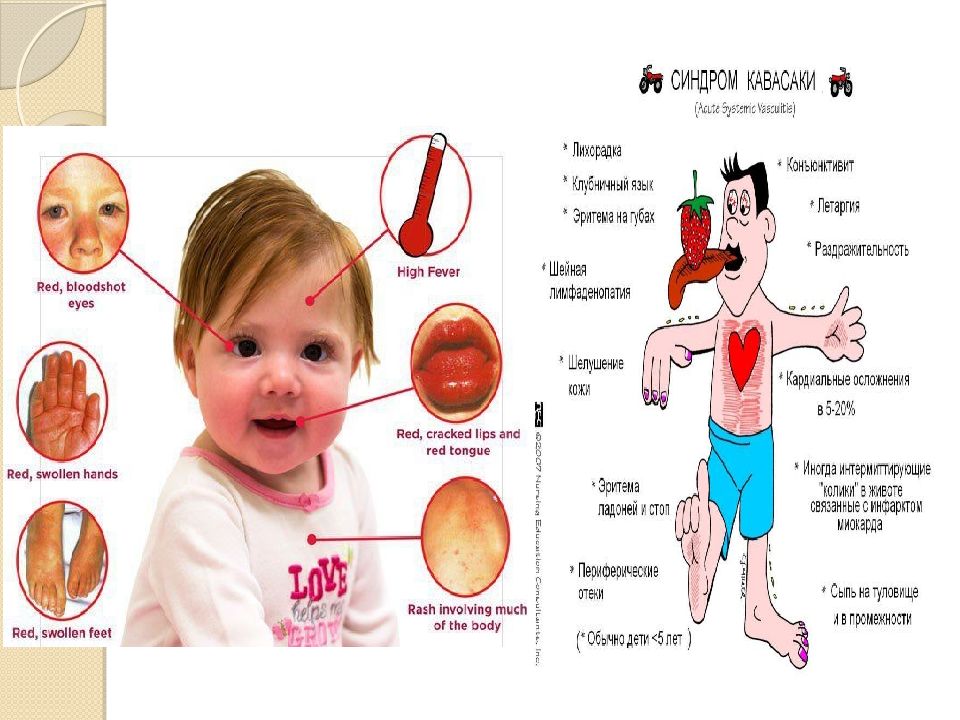 Болезнь кавасаки презентация