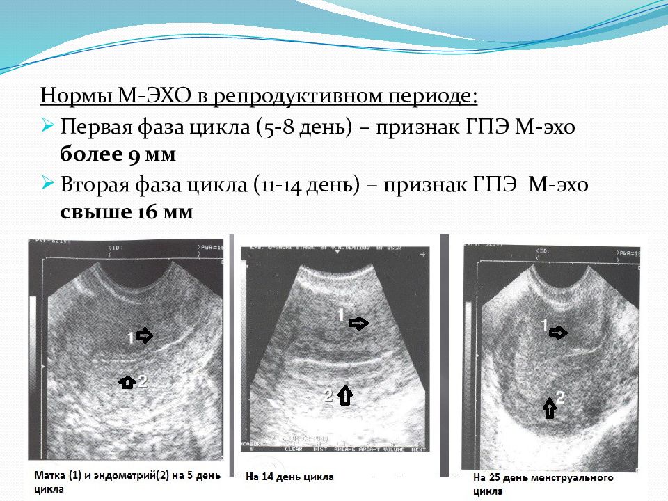 Эндометрий 6 5. М-Эхо матки мм норма 2 фаза МЦ. Толщина м Эхо в 1 фазу менструального цикла. Эндометрий по УЗИ по фазам цикла. На 5 день цикла эндометрий мм.