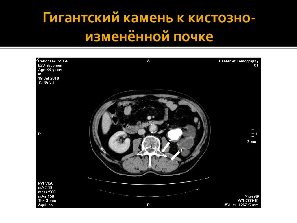 Плотность конкремента в почке. Плотность камней в почках на кт. Плотность конкрементов почек по кт.