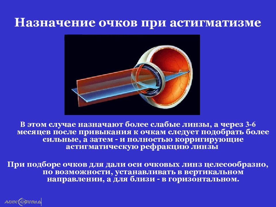 Астигматизм какой. Астигматические линзы сфера цилиндр. Астигматические очковые линзы. Цилиндрическая линза астигматизм. Коррекция астигматизма цилиндрическими линзами.