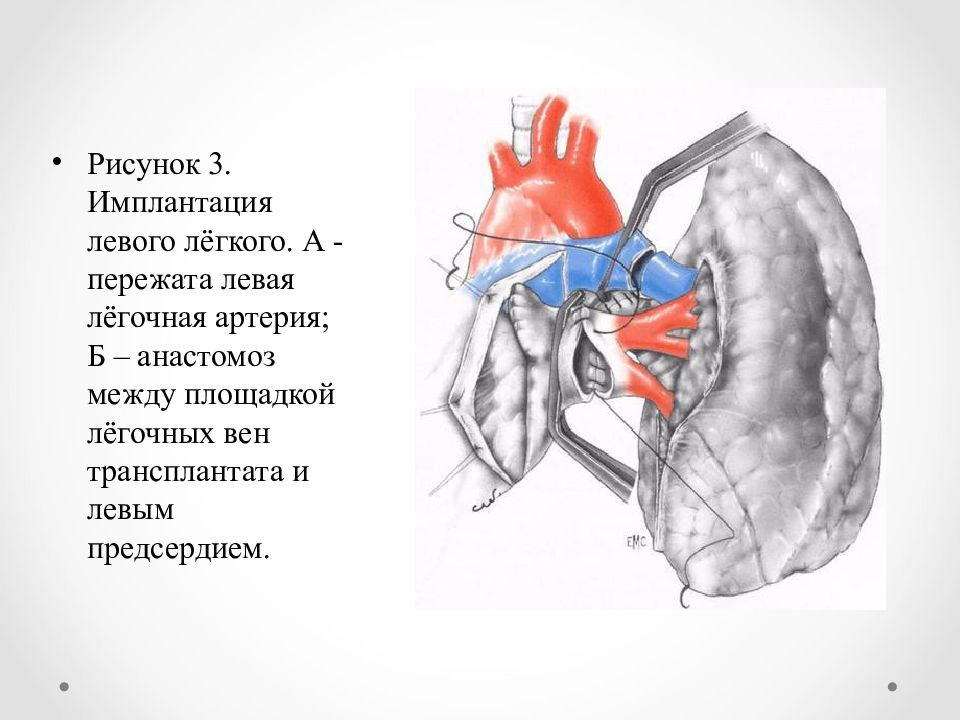 Трансплантация легких презентация