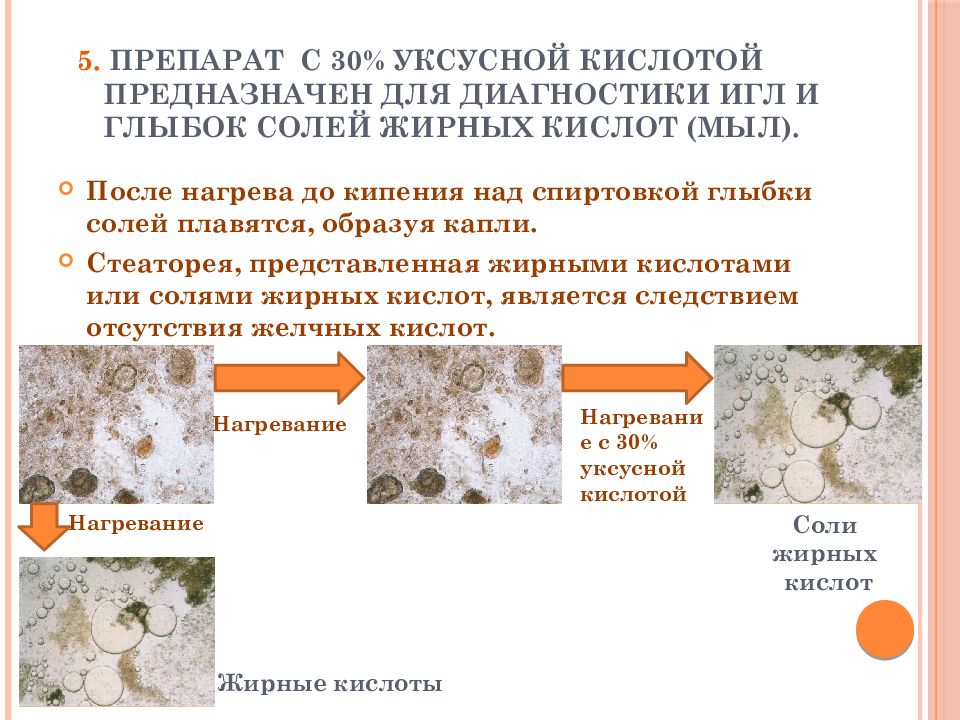 Жирные кислоты в кале. Соли жирных кислот. Препараты уксусной кислоты. Иглы и глыбки жирных кислот. Стеаторея жирными кислотами.