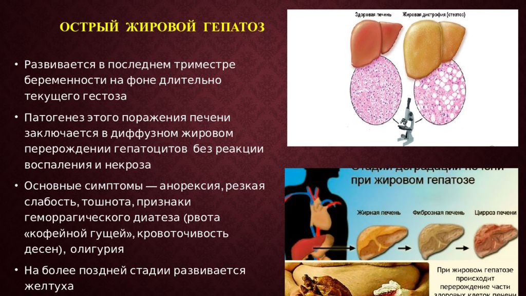 Причины жирового гепатоза печени лечение. Острый жировой гепатоз. Жировая дистрофия печени. Жировое поражение печени. Острый жировой гепатоз беременных.